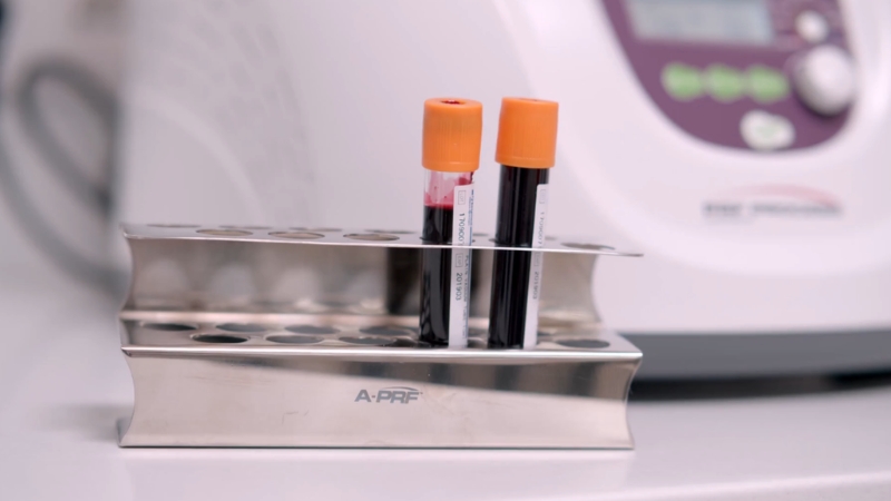 Epruvete sa uzorkom krvi stoje u metalnom držaču na laboratorijskoj površini