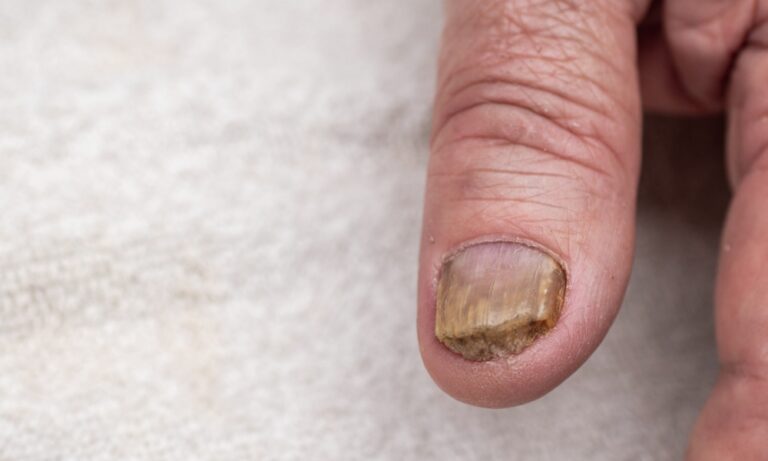 Gljivice na noktima – uzroci, simptomi i najefikasniji načini lečenja