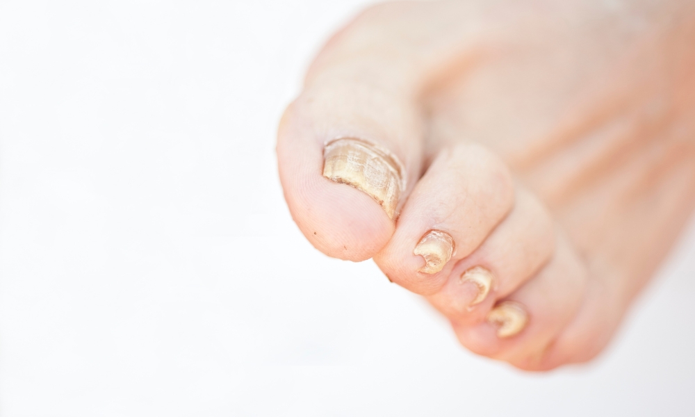 simptomi gljivica na noktima