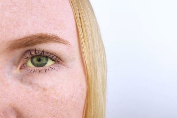 žute zenice kod devojke