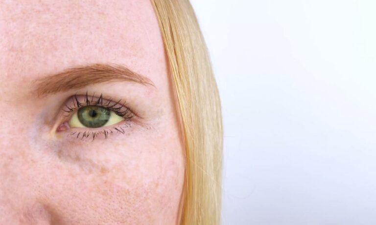 Povišen nivo bilirubina u krvi – Uzorci i simptomi