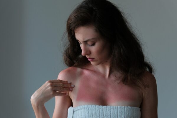 prikaz devojke sa iritacijom kože nakon sunčanja