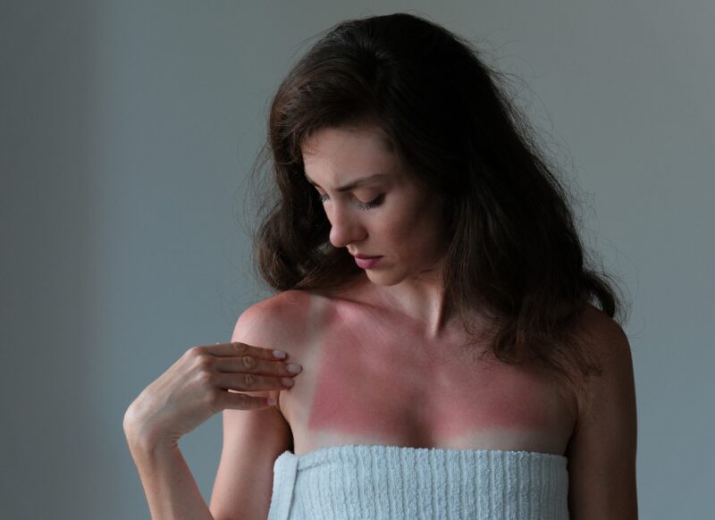 prikaz devojke sa iritacijom kože nakon sunčanja