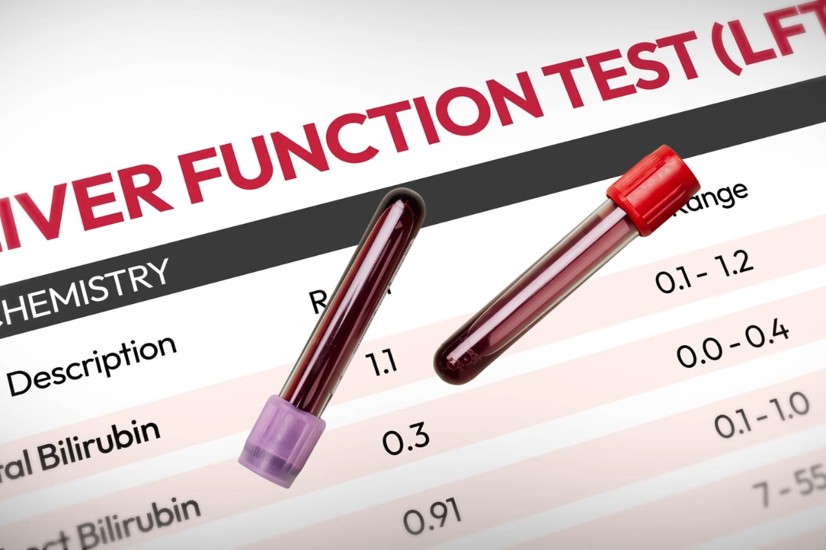 prikaz Bilirubin testa
