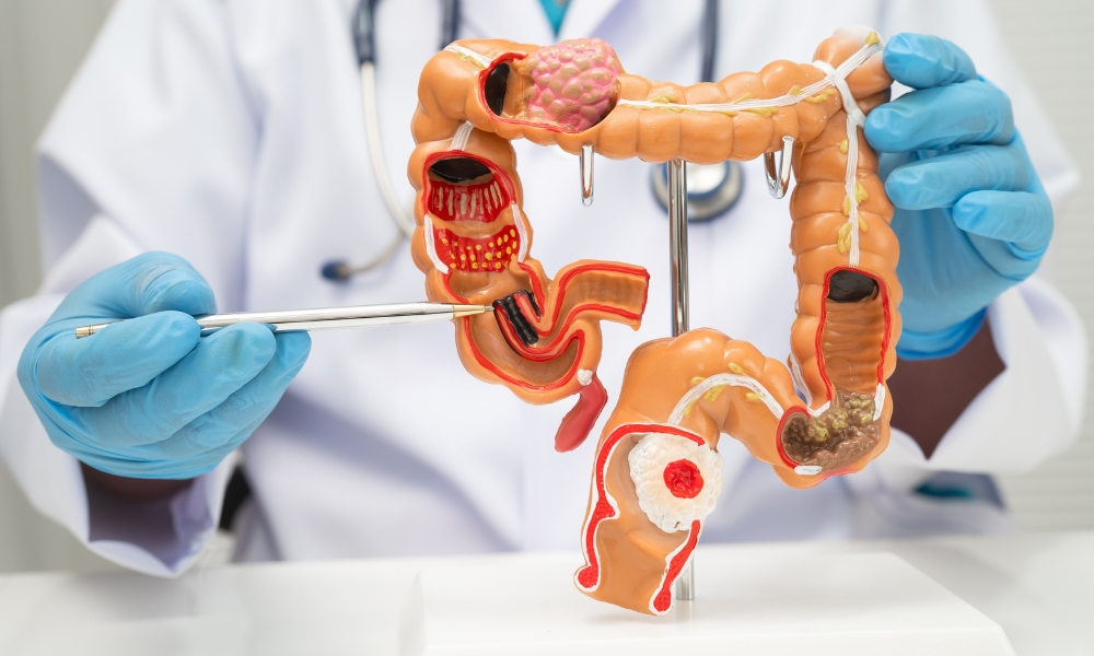 kada lekar traži fekalni kalprotektin